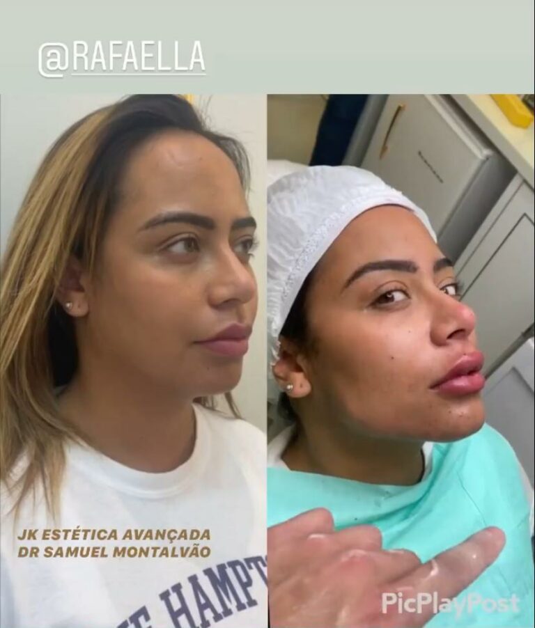 Antes E Depois Da Irmã Do Neymar Rafaella, irmã de Neymar, realiza série de procedimentos estéticos no