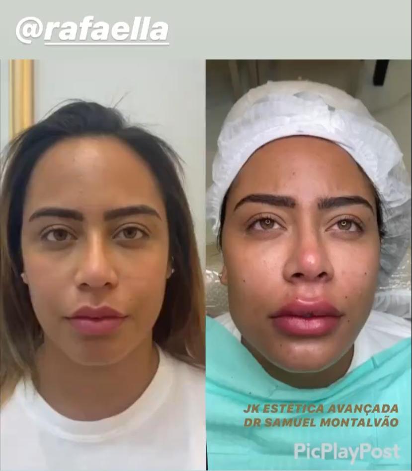 Antes E Depois Da Irmã Do Neymar Rafaella, irmã de Neymar, realiza série de procedimentos estéticos no