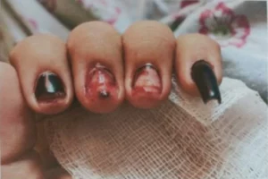 Jovem mostra unhas sangrando apos ser agredida por ex em Aparecida de Goiania Goias 1024x681 1