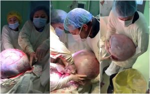 medicos tumor gigantesco 27082019180105611