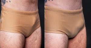 Foto Antes e Depois
