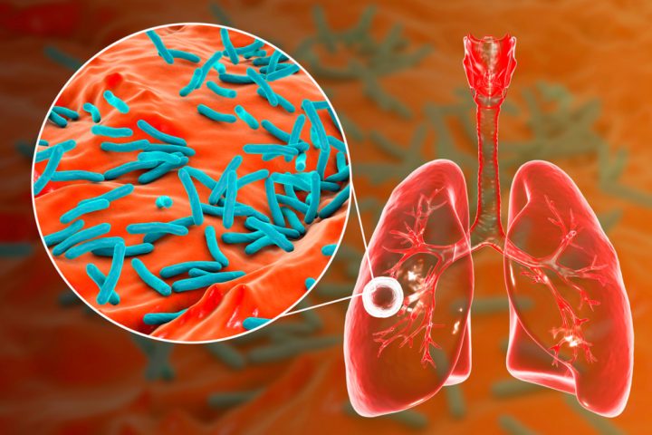 tuberculose 1