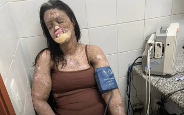 Influenciadora com Xeroderma Pigmentoso emociona ao revelar avanço do câncer