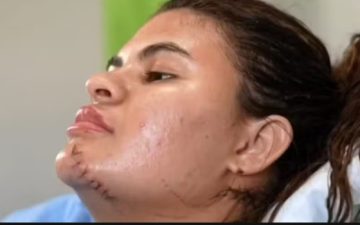 Jovem que teve as mãos decepadas teme não conseguir mais se comunicar com a mãe surda