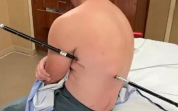 Enfermeiro anda 16 km com uma vara atravessada no corpo após acidente em montanha