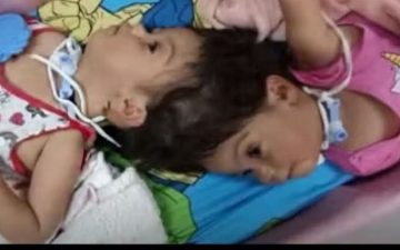 Heloísa e Helena, de 2 anos e 7 meses, morrem durante última cirurgia do processo de separação